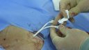 Medcomp Split stream catheter insertion